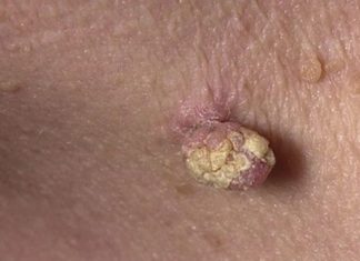 Удаление больших папиллом