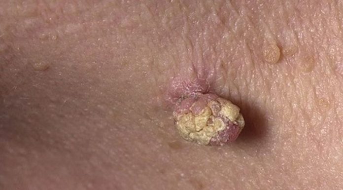 Удаление больших папиллом