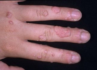 Стоит ли выводить бородавки на пальцах