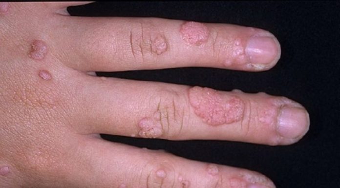 Стоит ли выводить бородавки на пальцах