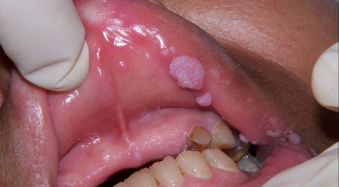 Локализация и виды папиллом во рту