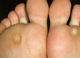 Бородавка куриная жопка