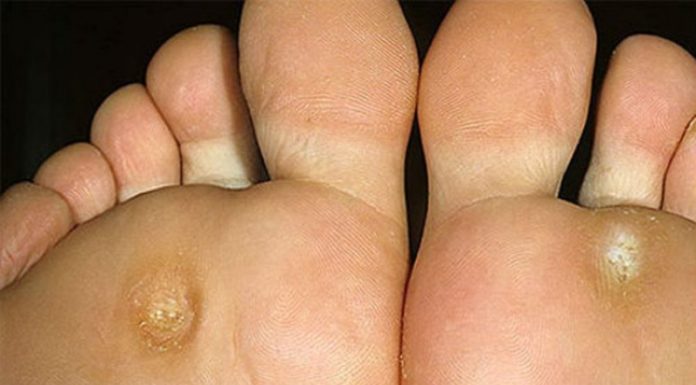 Бородавка куриная жопка