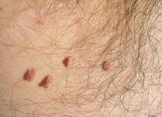 Бородавки в паху