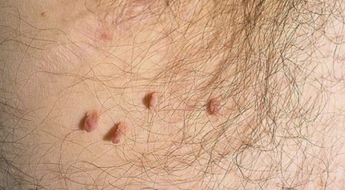 Бородавки в паху