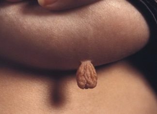 Бородавки на грудной клетке, в области соска или под молочной железой