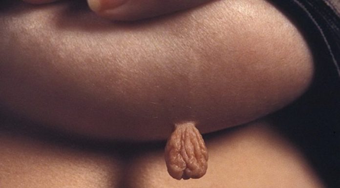 Бородавки на грудной клетке, в области соска или под молочной железой