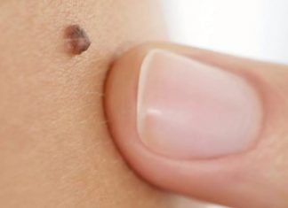 Как отличить родинку от бородавки