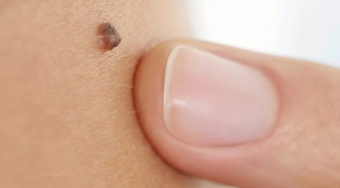 Как отличить родинку от бородавки