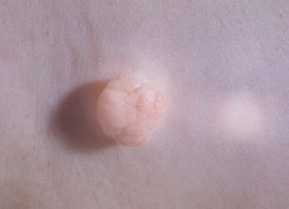 Иммунитет и вирус папилломы человека