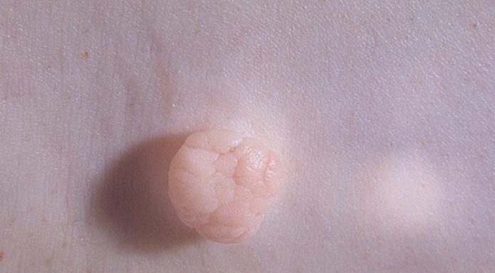 Иммунитет и вирус папилломы человека