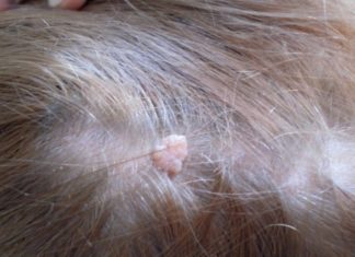 Какими бывают бородавки на голове