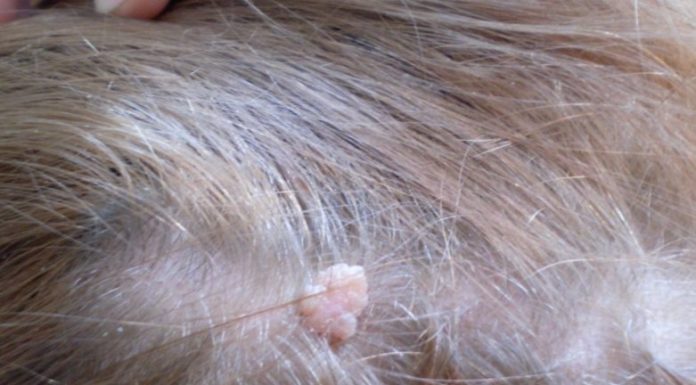 Какими бывают бородавки на голове