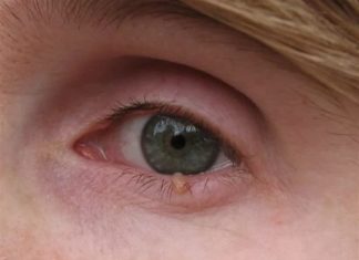 Разновидности папиллом и их опасность