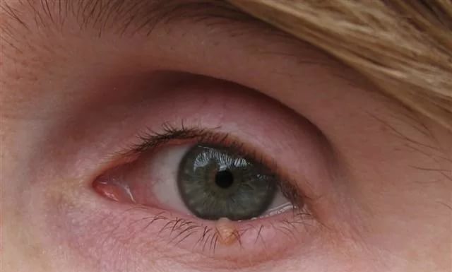 Разновидности папиллом и их опасность