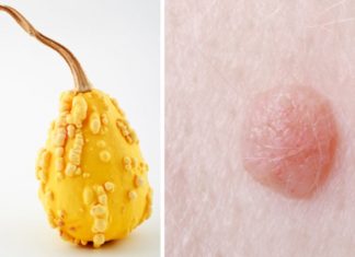 Мази и крема от бородавок