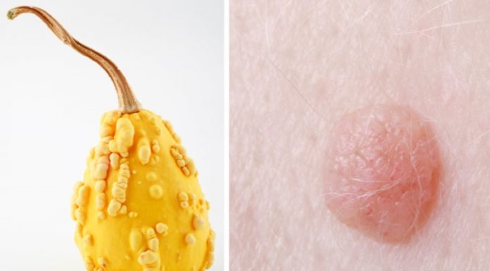 Мази и крема от бородавок