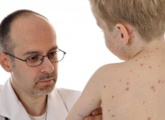 Опоясывающий герпес у детей