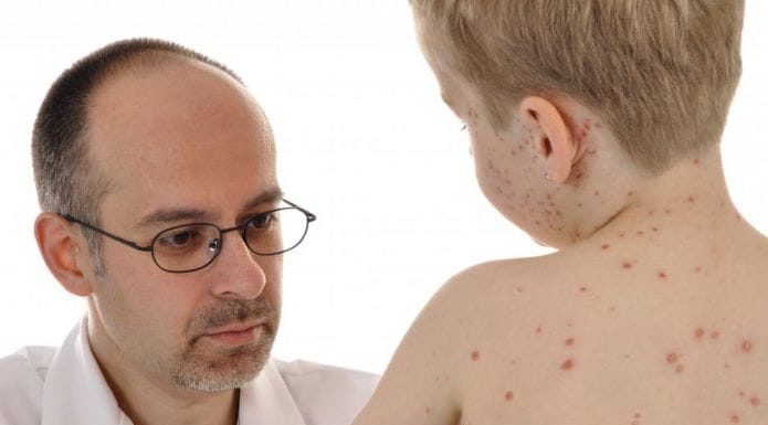 Опоясывающий герпес у детей