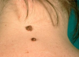 Что делать если папиллома растет