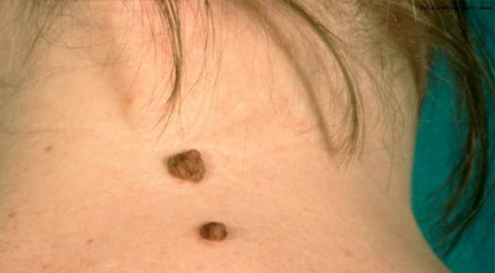 Что делать если папиллома растет