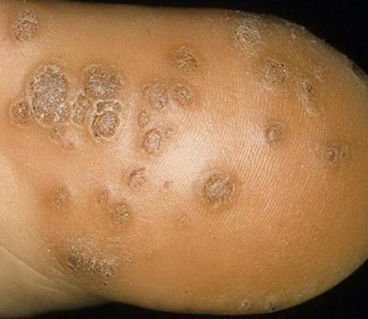 Удаление куриной жопки народными методами