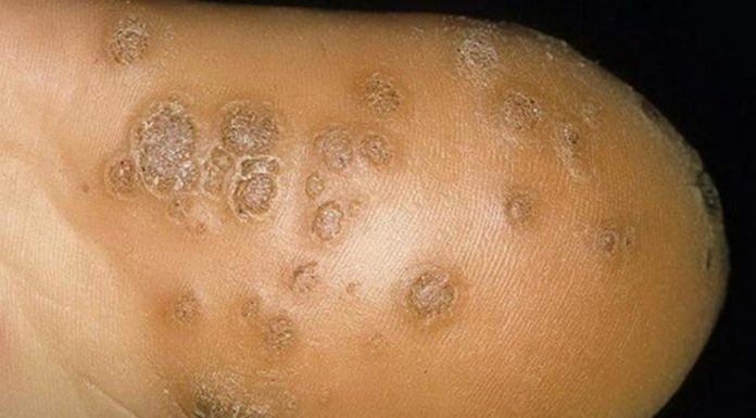 Удаление куриной жопки народными методами