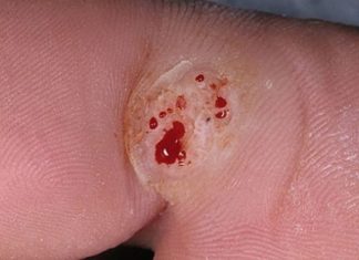 Что будет, если оторвать бородавку полностью или сильно её повредить