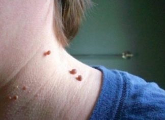 Схожесть и разница между папилломами и бородавками