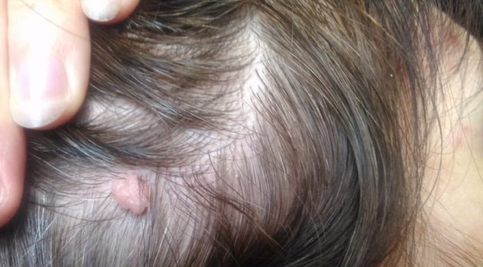 Папилломы в волосах