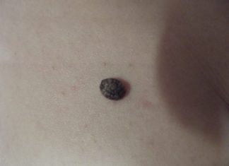 По каким причинам бородавка чернеет