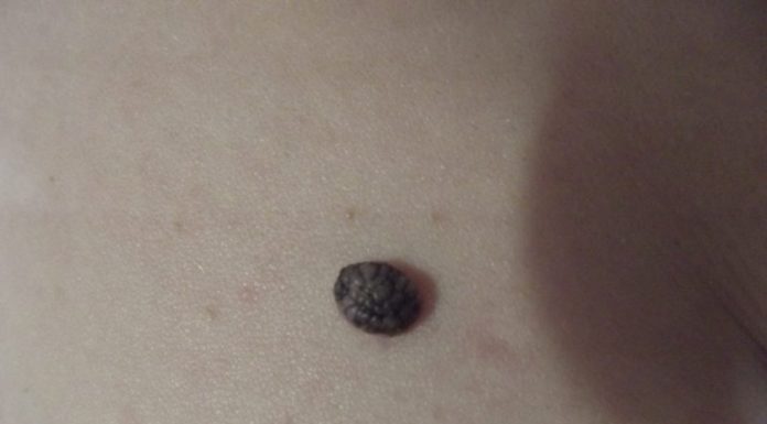 По каким причинам бородавка чернеет