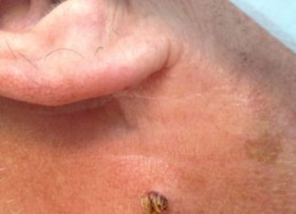 Мазь Левомеколь от папиллом