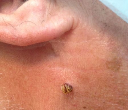 Мазь Левомеколь от папиллом