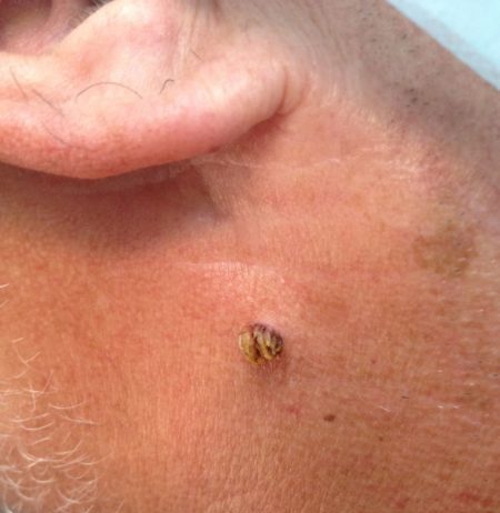 Мазь Левомеколь от папиллом