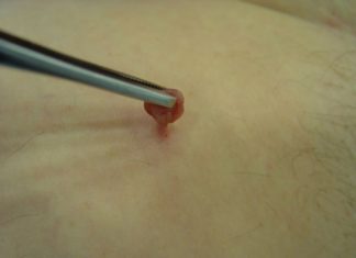 Лечение папиллом йодом