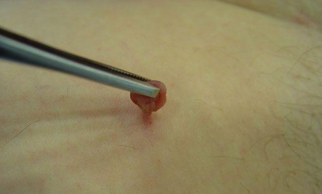 Лечение папиллом йодом