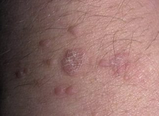 Удаляем плоские бородавки на теле