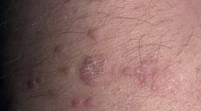 Удаляем плоские бородавки на теле