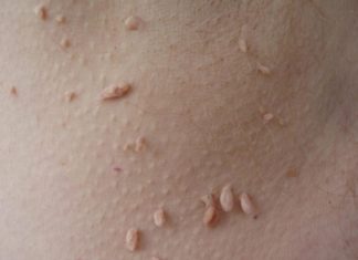 Папилломы у женщин