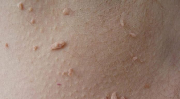 Папилломы у женщин