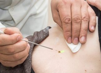 Стоимость удаления бородавки