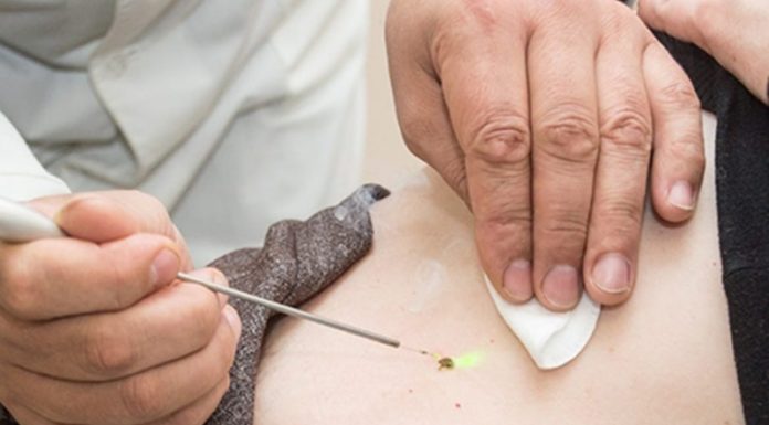 Стоимость удаления бородавки