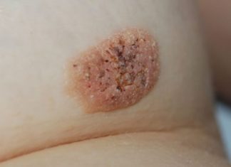 Виды и особенности лечения бородавок