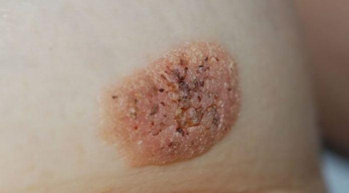 Виды и особенности лечения бородавок