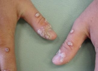 Лечение плоских бородавок на руках