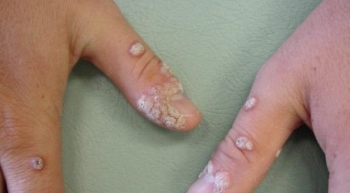 Лечение плоских бородавок на руках