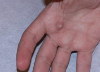 Раствор “Papillock Plus”