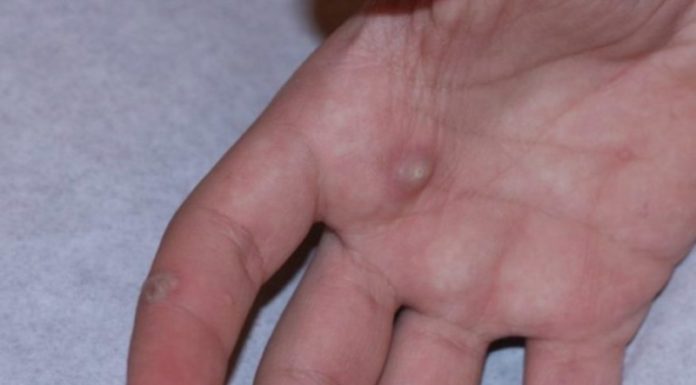 Раствор “Papillock Plus”