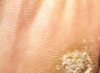 Лечение бородавки на пятке